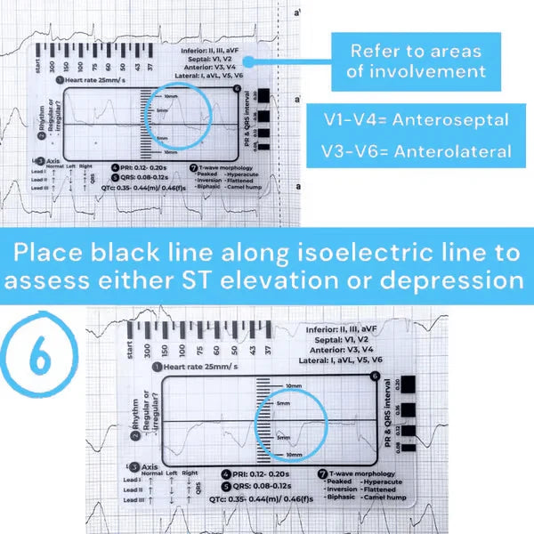 Purpose-Built ECG 7 Step Ruler for Everyday Use