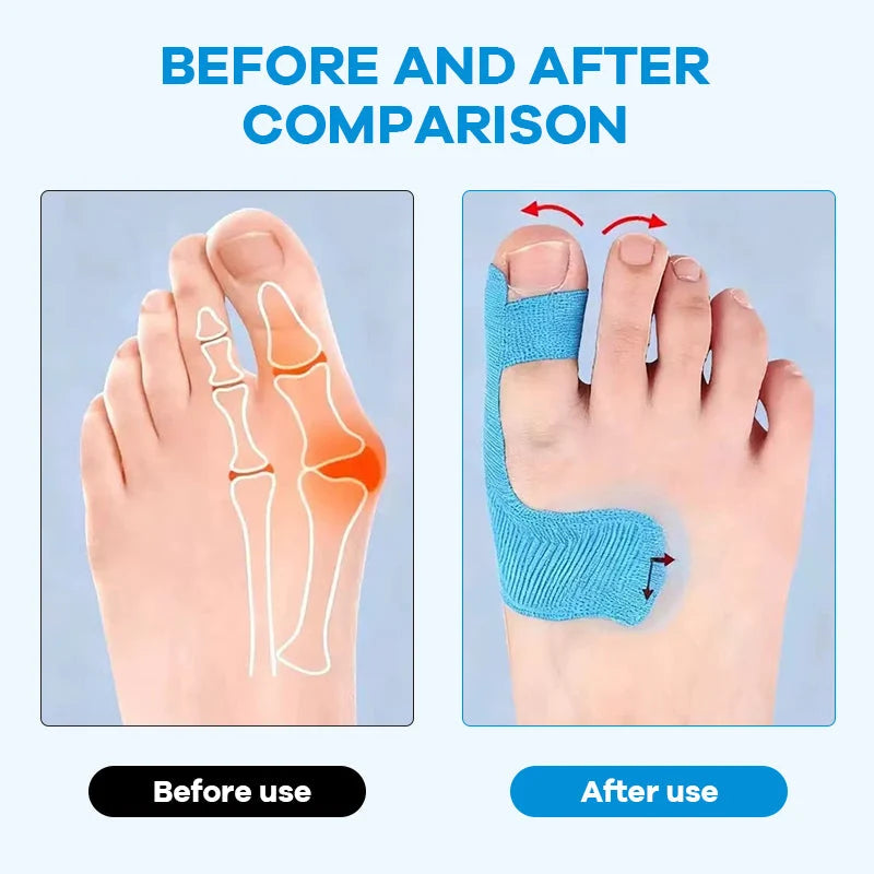 Purpose-Built Pre-cut Bunion Corrector Kinesiology